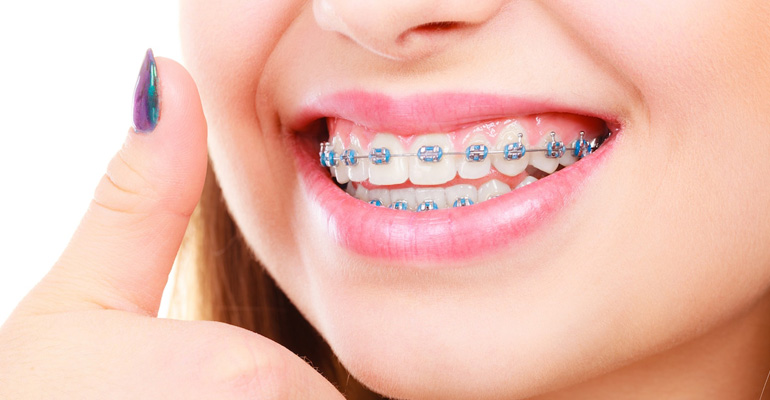 Orthodontic Treatment Brampton